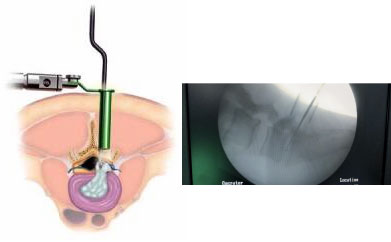 Stichless Spine Surgery