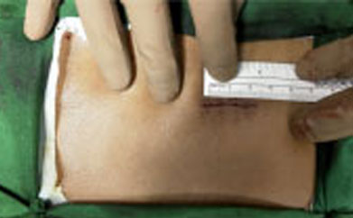 Incision as small 2cm