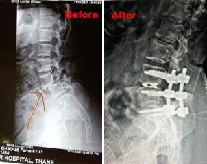 Lumbar Fusion Surgery