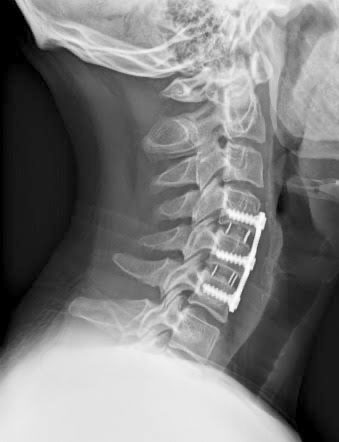 Cervical Decompression & Fusion Surgery